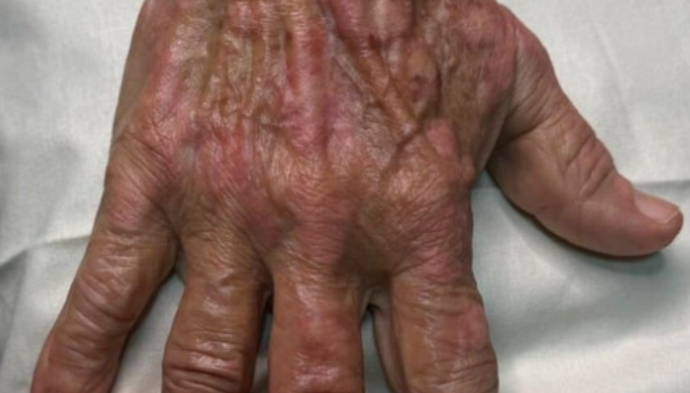 Depois: Camuflagem de Vitiligo
